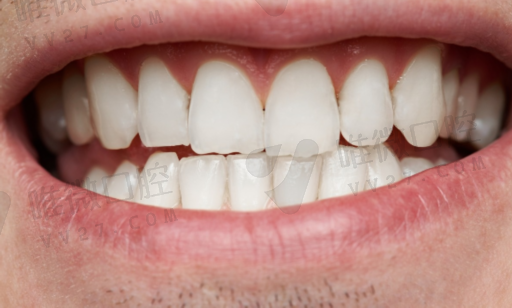 窝沟封闭牙面处理方法及牙釉质损伤修复方法(图1)